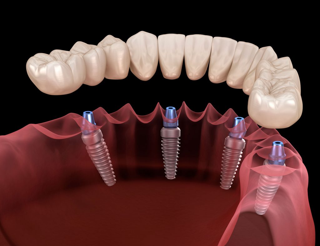 Dental implants and implant crowns and bridges