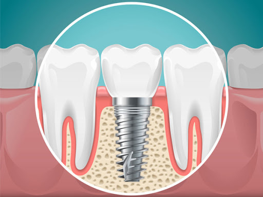Dental Implants Leicester